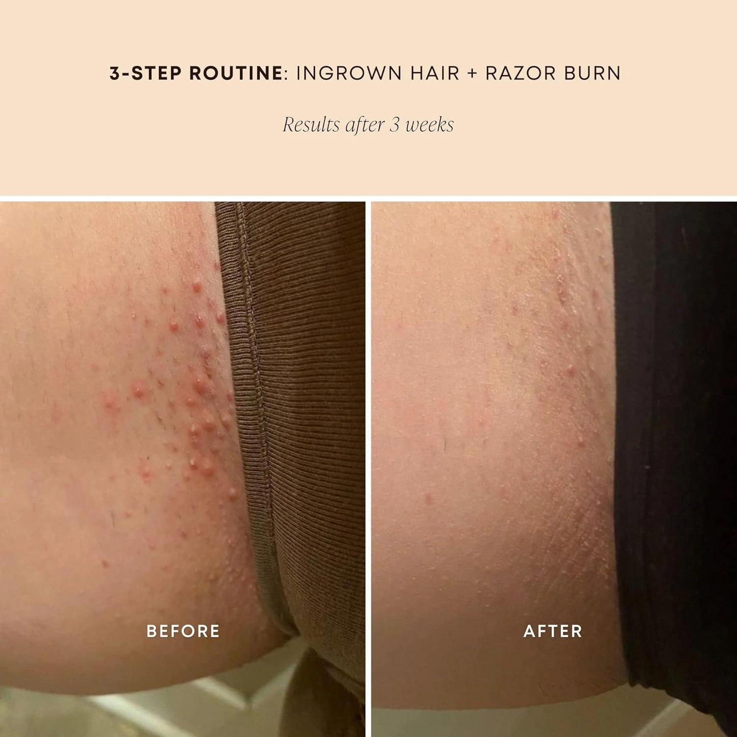 Bushbalm Ingrown Razor Bumps 3 Step Routine - Ingrown Hair Oil (30 ml), Exfoliating Scrub (236 ml), and Nordic Dry Brush - Nude Scent